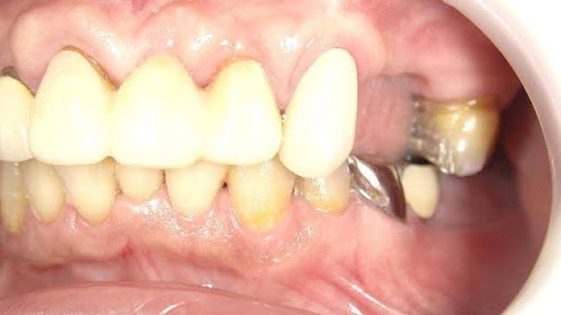 枚方市のインプラントの症例