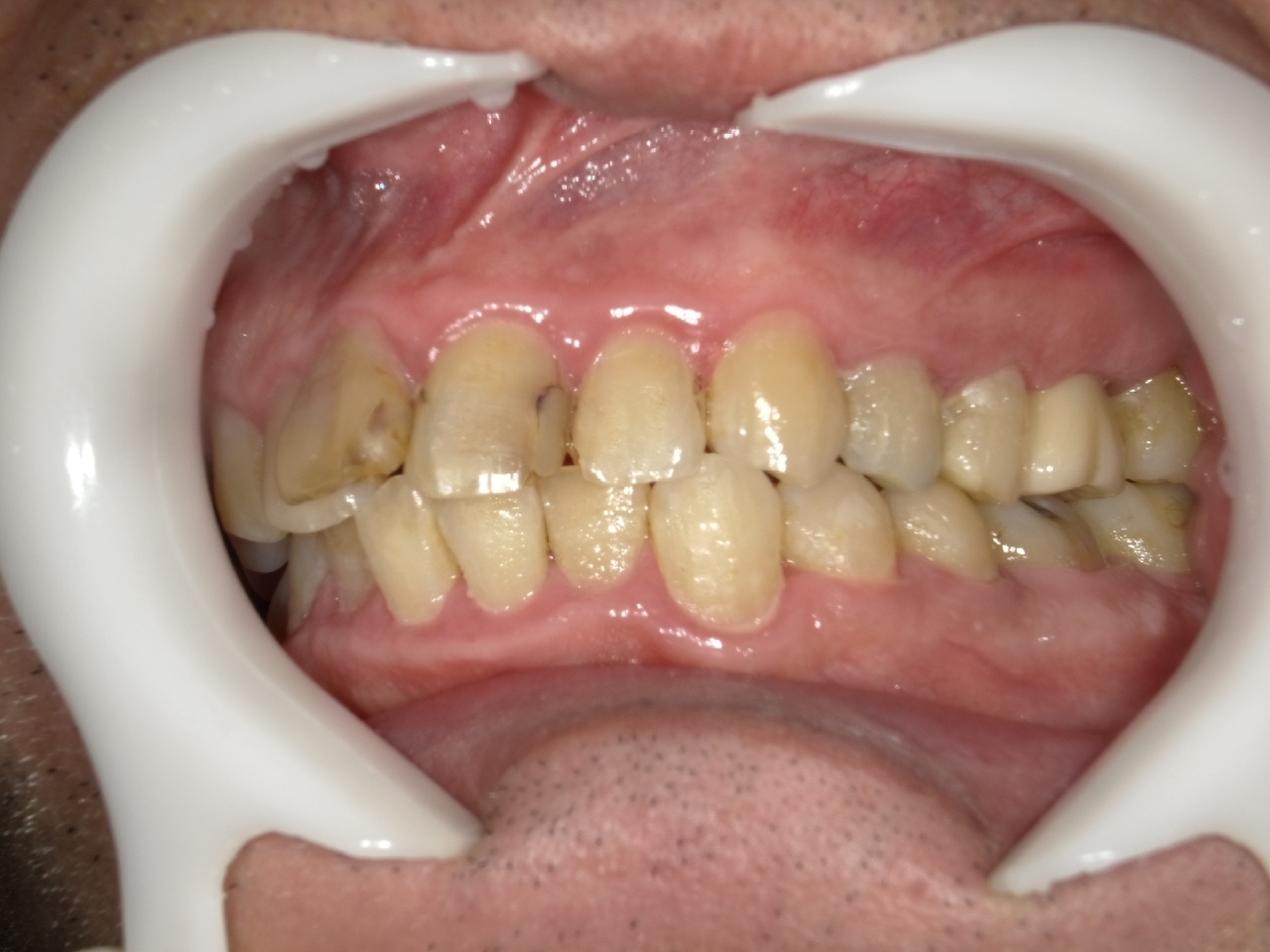 枚方市のインプラントの症例