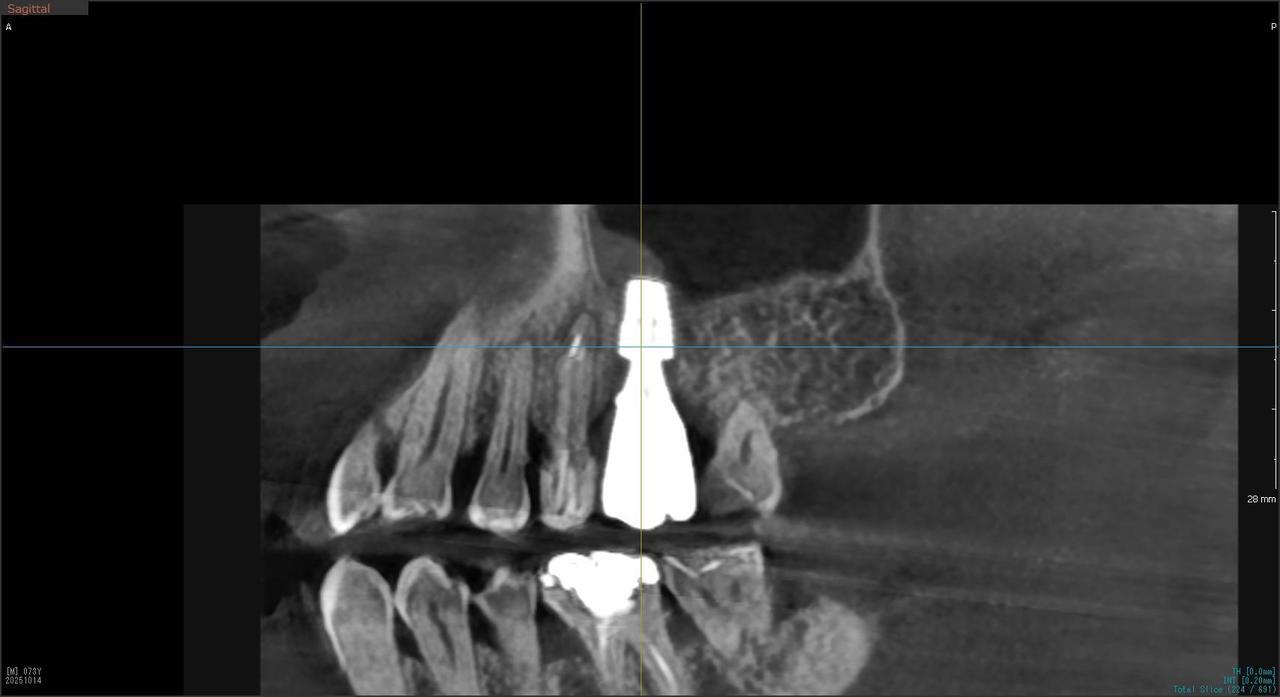 枚方市のインプラントの症例