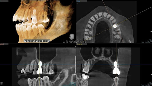 枚方市のインプラントの症例