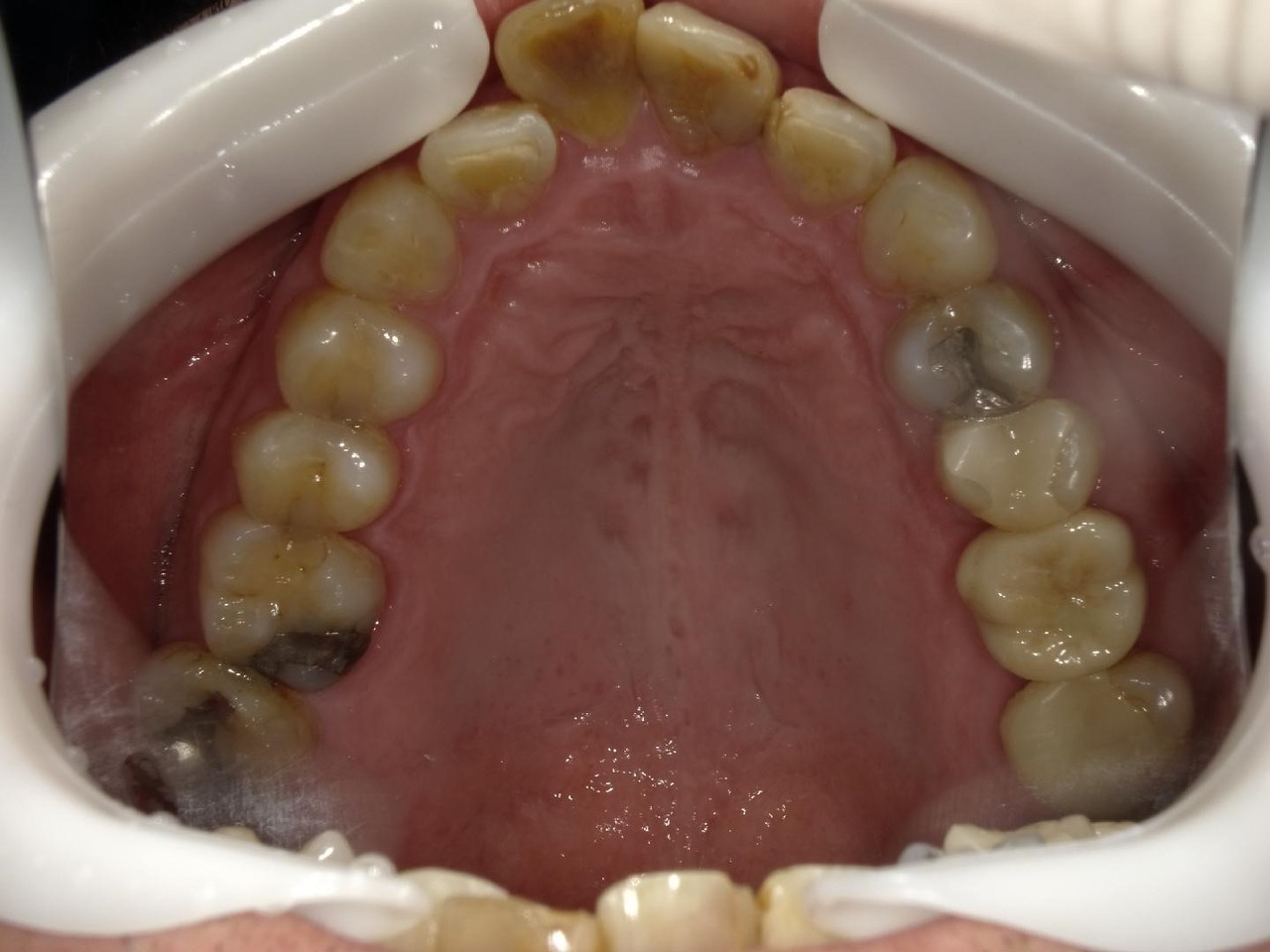 枚方市のインプラントの症例