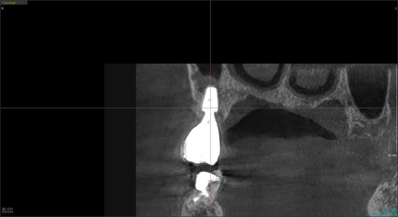 枚方市のインプラントの症例