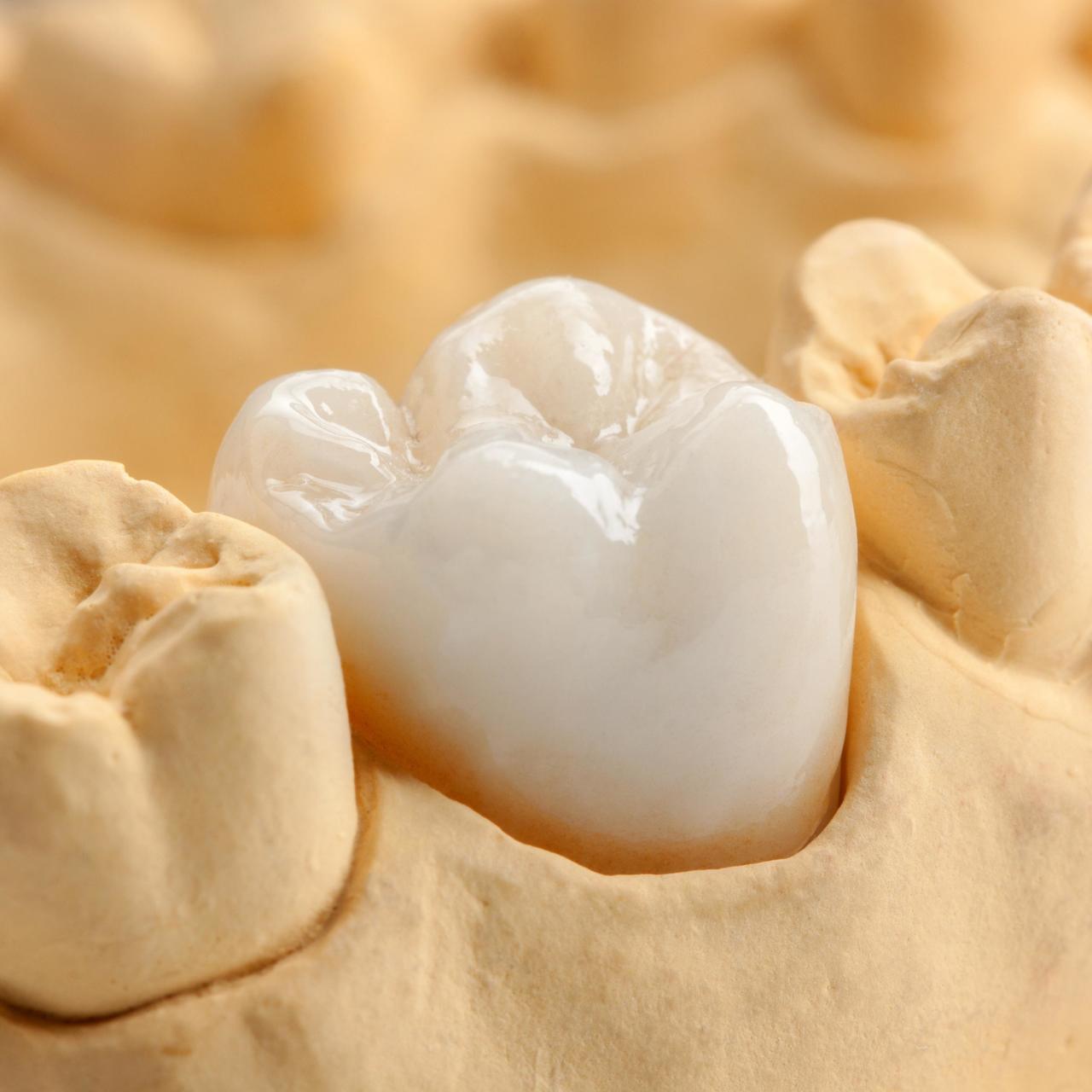 枚方市のメタルフリー治療 