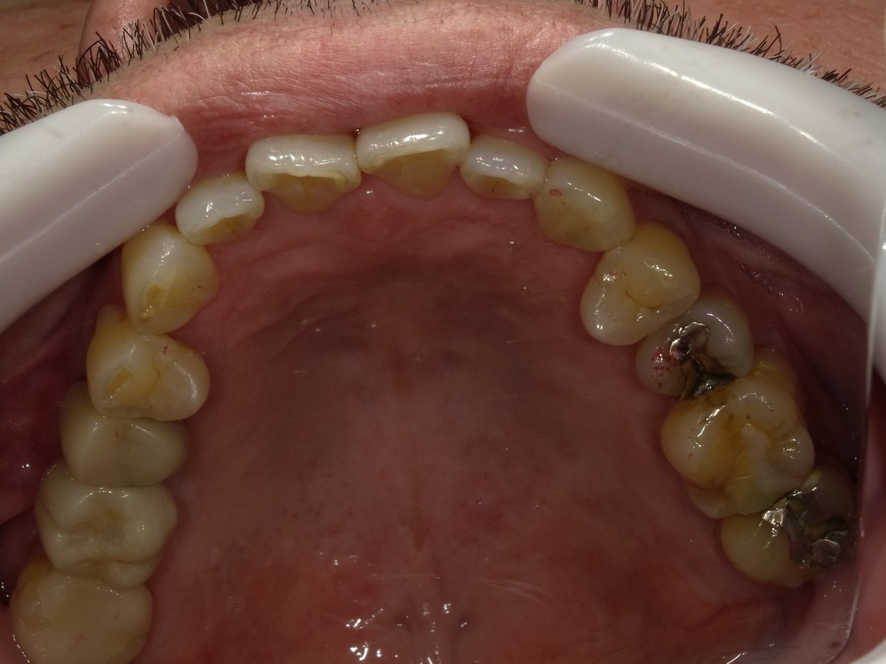 枚方市のインプラントの症例