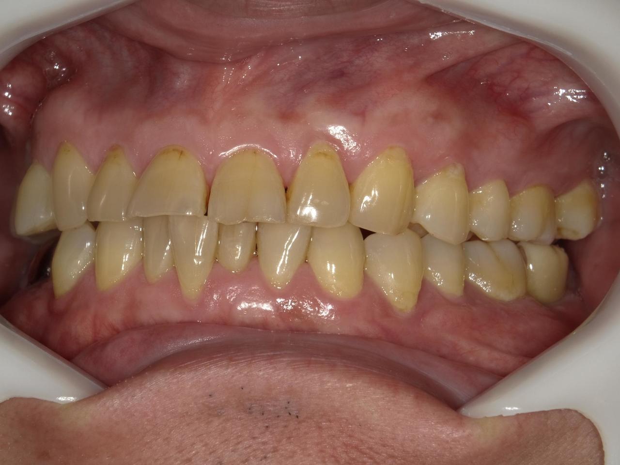 枚方市のインプラントの症例