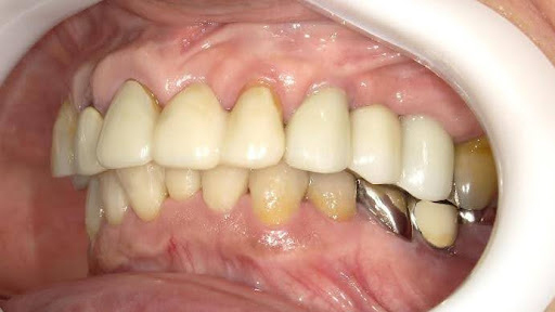 枚方市のインプラントの症例