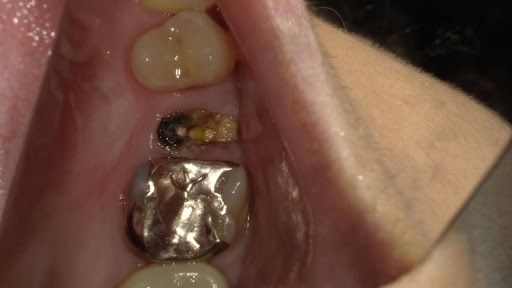 枚方市のインプラントの症例