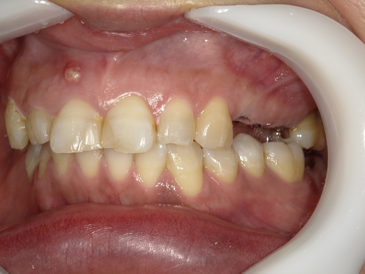 枚方市のインプラントの症例