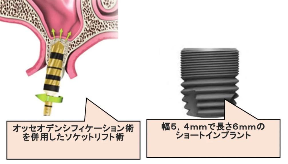 枚方市のインプラントのこだわり