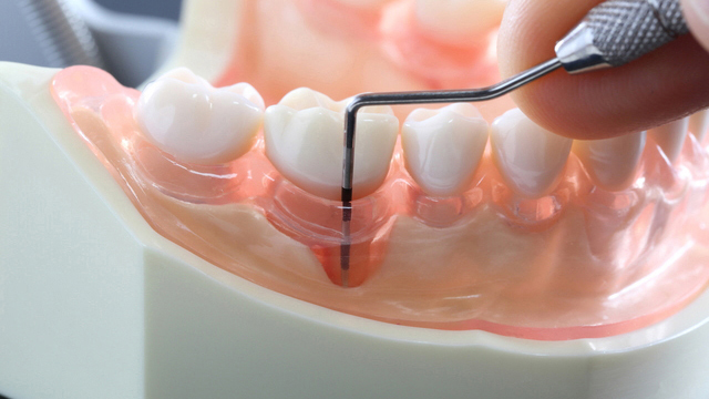 枚方市の歯周病治療