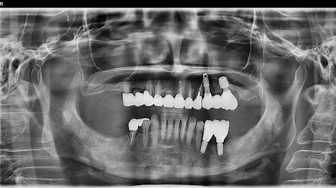 枚方市のインプラントの症例