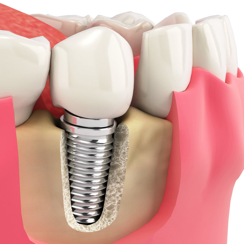 枚方市の「健康寿命を延ばす」 老後に向けたインプラント治療