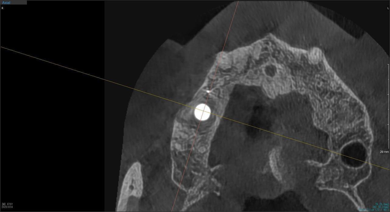 枚方市のインプラントの症例