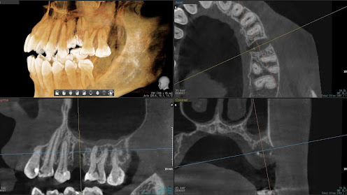 枚方市のインプラントの症例