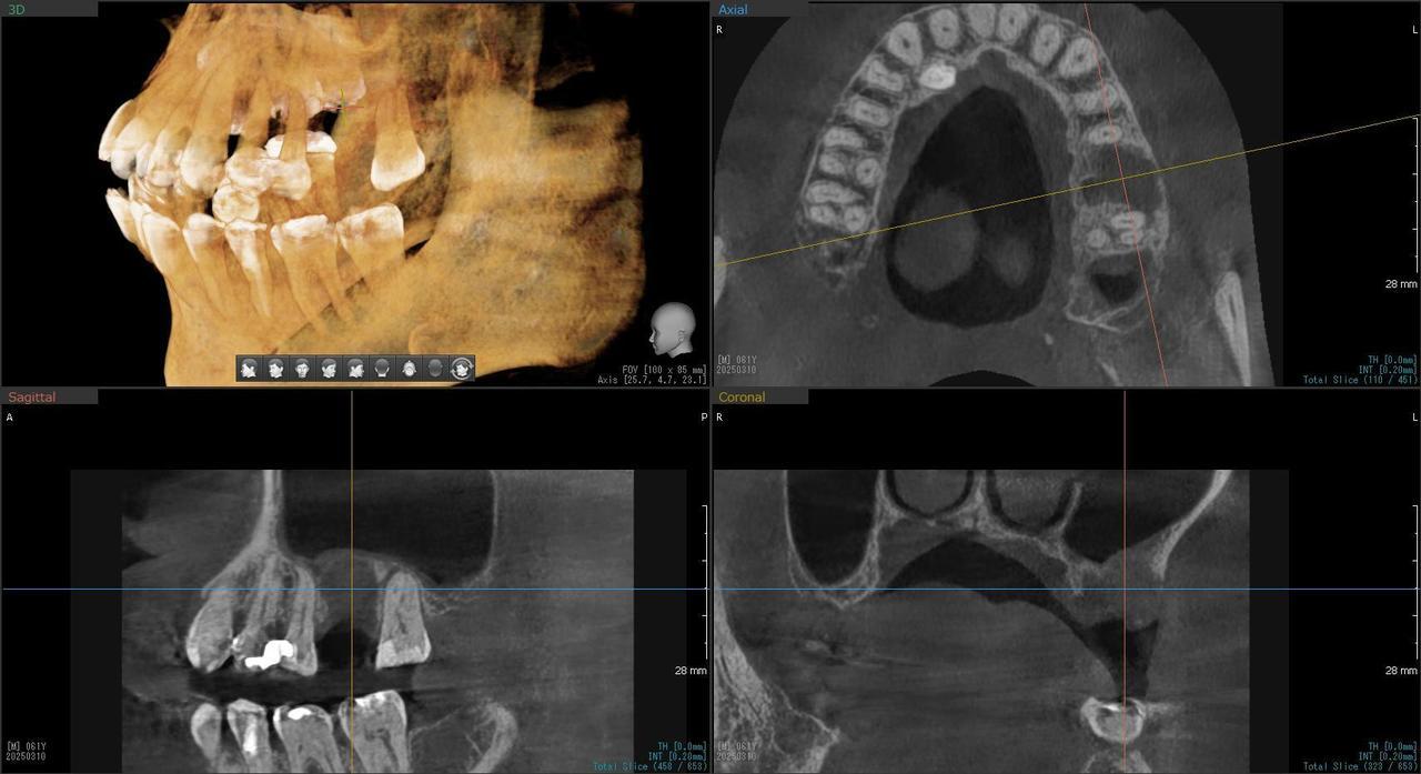 枚方市のインプラントの症例