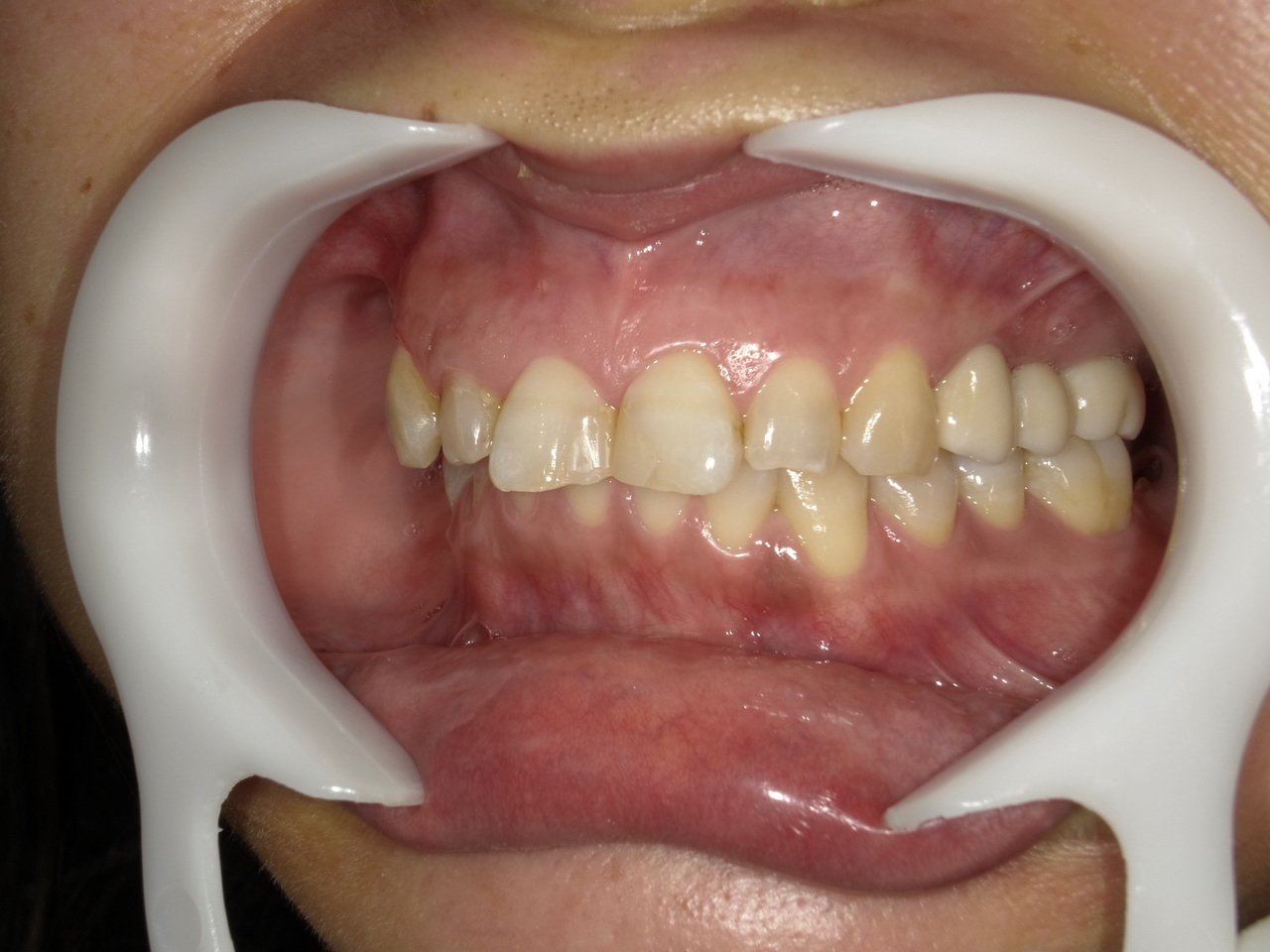 枚方市のインプラントの症例