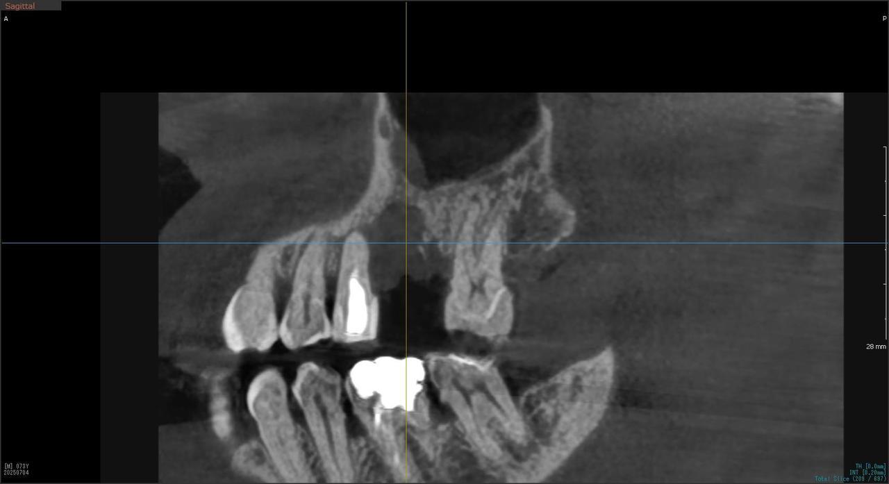 枚方市のインプラントの症例