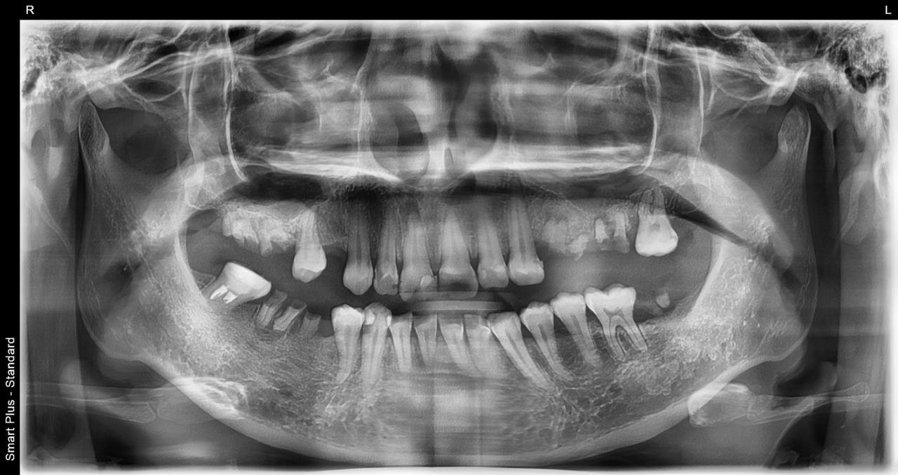 枚方市のインプラントの症例
