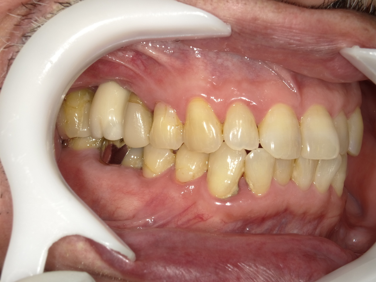 枚方市のインプラントの症例