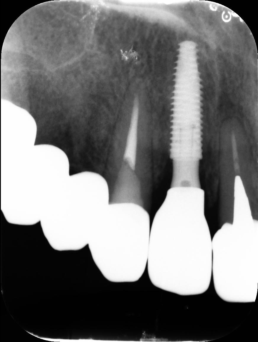 枚方市のインプラントの症例
