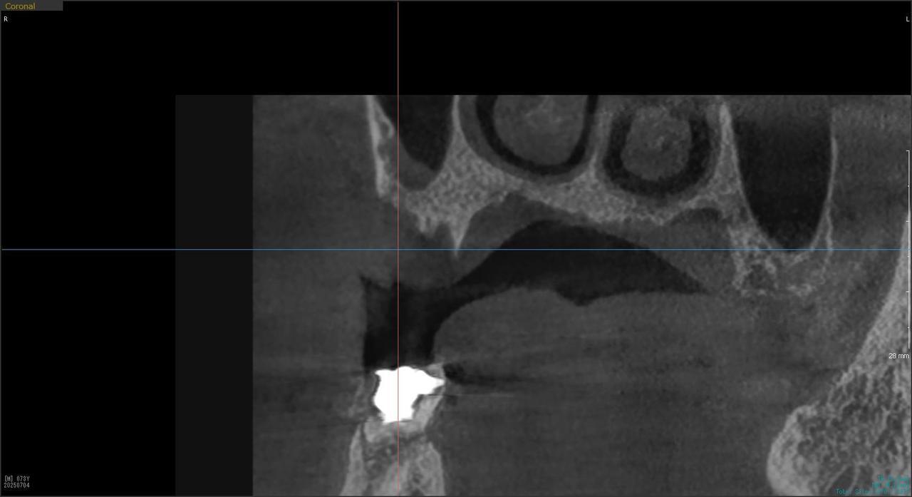 枚方市のインプラントの症例