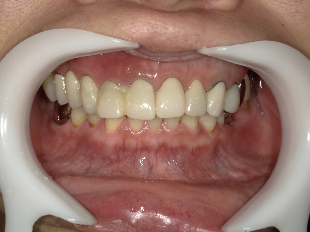 枚方市のインプラントの症例