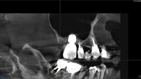 枚方市のインプラントの症例